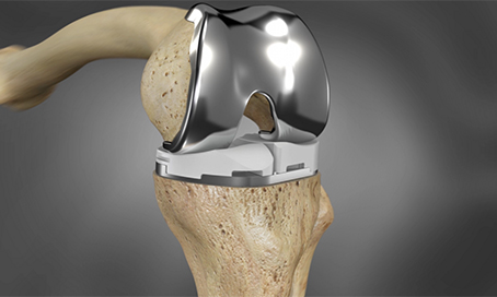 FT3D Knee Resurfacing Recovery