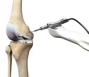 ft 3d knee resurfacing specialist