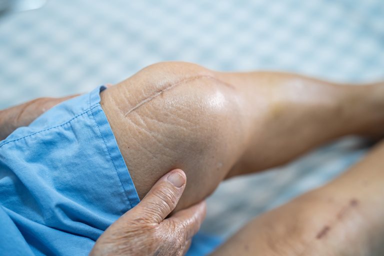 Knee replacement surgery Chandigarh