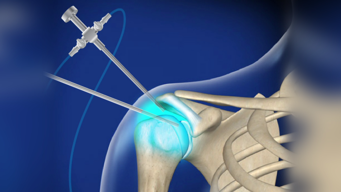 Shoulder Arthroscopy in Chandigarh